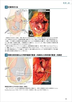 骨折治療 手術アプローチがよくわかる髄内釘・プレート固定 | 渡部 欣